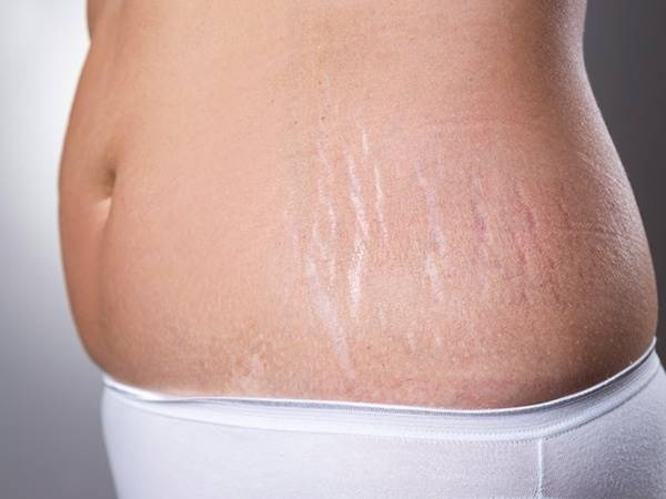 Vết rạn da sau khi sinh con